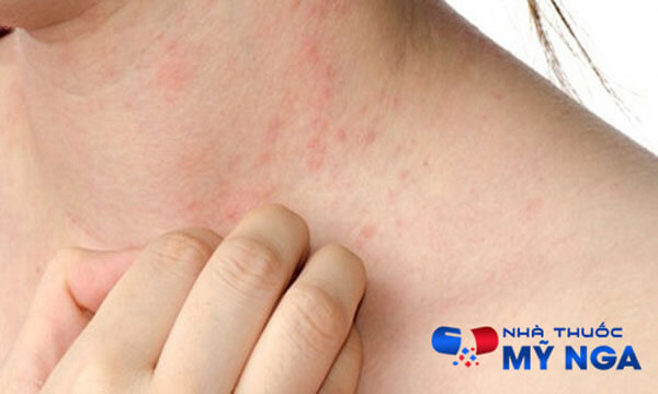 Nổi nhiều mẩn đỏ hoặc phát ban